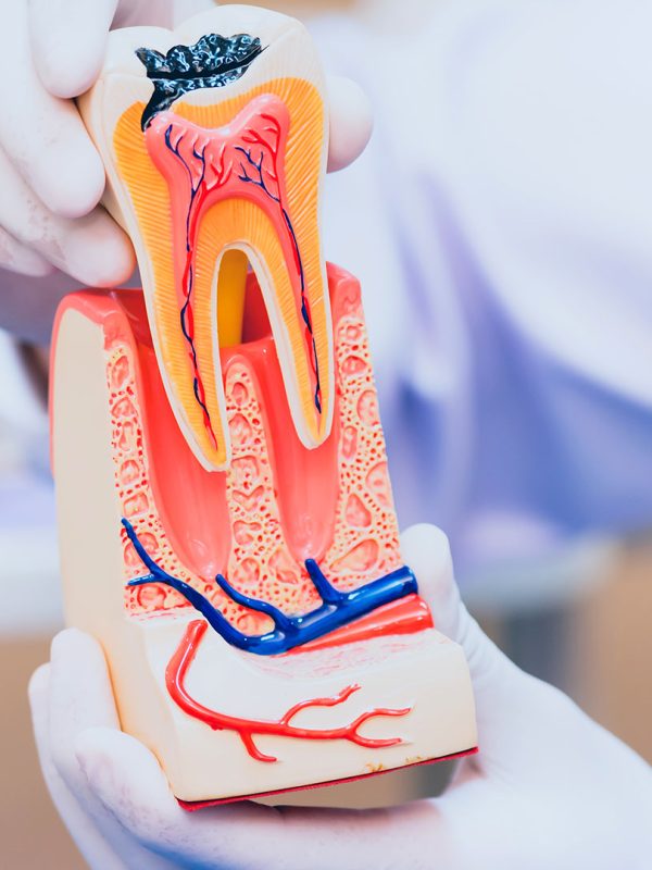 Root Canal Therapy